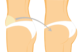 Fetttransfer/Lipotransfer