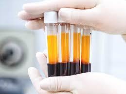 Hautverjüngung mit PRP(pletelet rich plasma) –Therapie/ Vampir- Lifting