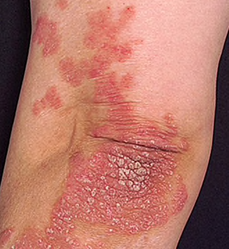 Schuppenflechte/ Psoriasis